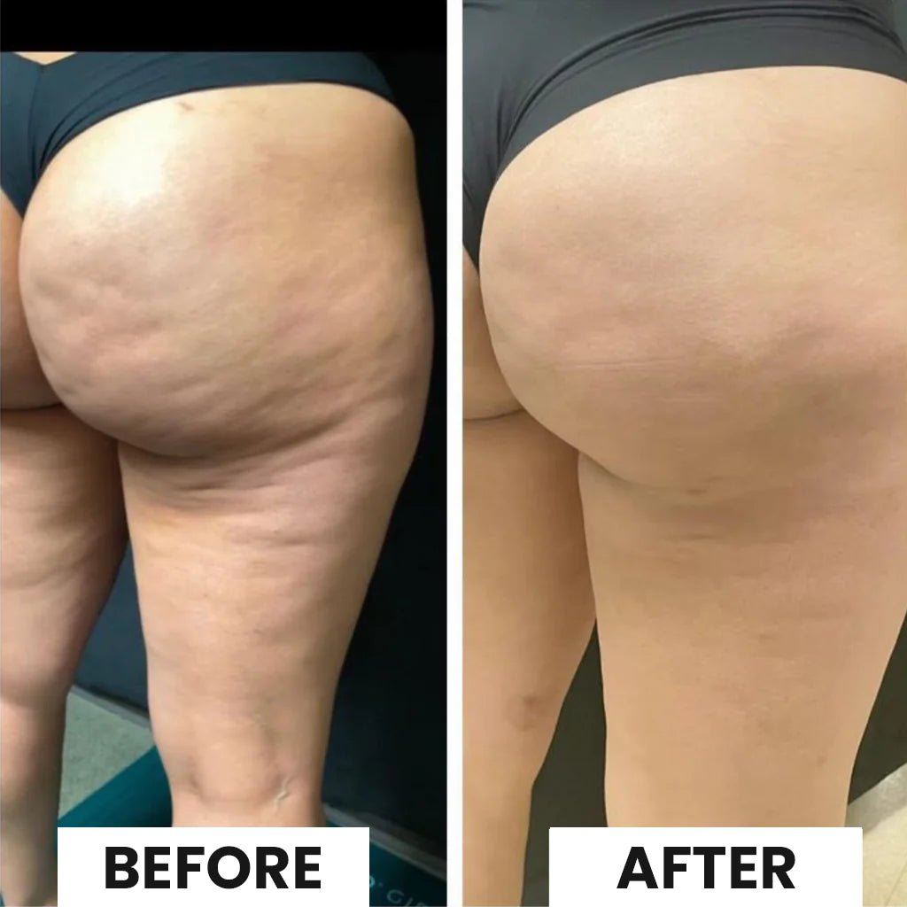 CurveRevive™ Cellulite Relief Kit
